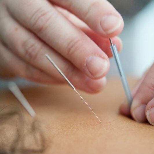 acupuncture in pregnancy | acupuncture in third trimester | West End Mamas