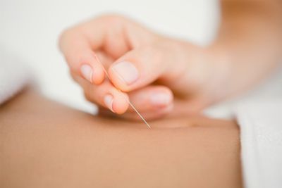 Acupuncture needles being used on pregnant woman