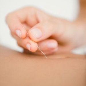 Acupuncture needles being used on pregnant woman